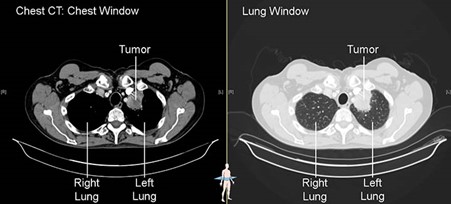 CT scan lung cancer